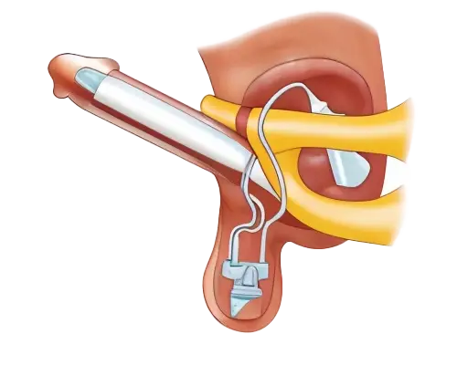 شكل القضيب بعد الانتصاب