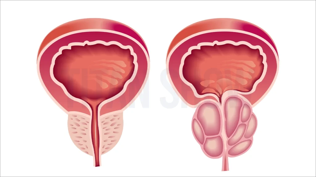 تضخم البروستاتا وعلاجاته في تركيا