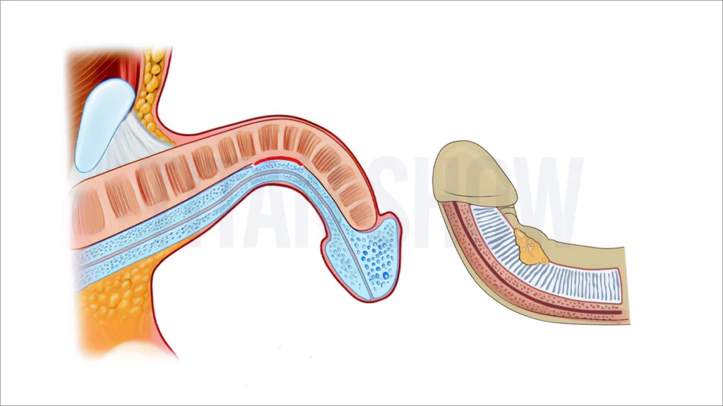 داء بيروني وعلاجه في تركيا